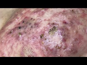 Relax Every Day With nasa Spa | acne skin blackheads #11