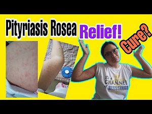 What is Pityriasis Rosea || My skin Condition