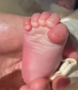 161K views · 460 reactions | El signo de Babinski, también conocido...