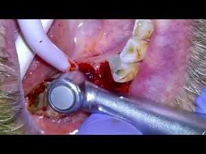 [28] Surgical Tooth Extraction