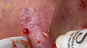 Heavily Inflamed, Highly Explosive Cystic Acne Cheek from Thuy at SDS. Nice core launches, sebum everywhere, tons of blood (TW) . Glorious.