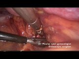 Internal Iliac Artery Ligation and Myomectomy • Video • MEDtube.net