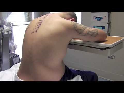 Ultrasound-guided Paravertebral Block