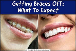 What To Expect When Getting Braces Off - Orthodontic Braces Care