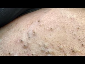 Blackhead Removal That Actually Works — Before & After Results