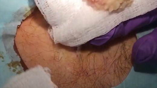 Man has giant cyst removed and it's huge