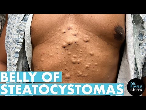 A Belly Full of Steatocystomas - Part 2! (13 Minutes!)