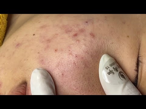 Inflammatory acne hematoma, hidden acne (Tham P.2) #HoangMySpa109