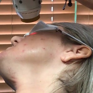 #NeoClearbyAerolase is the in-office acne solution for all forms of acne, no prescription medication required. Become a NeoClear practitioner - send us a message Practitioner: SkinAppeal Spa | Aerolase | Facebook