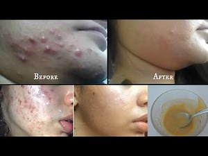 DIY Home remedy to Get rid of Chin Acne / Jawline acne || 3 steps to get rid of acne at home