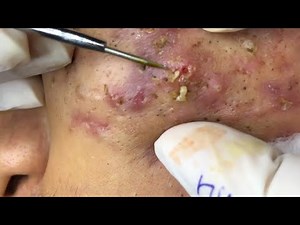 Blackhead Extractions | Blackheads Removal | Acne Treatment | Big Cystic Acne Extraction