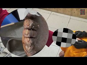 🛑 Extreme Jigger Build-Up – Thick Plates of Skin Detached! #JW172