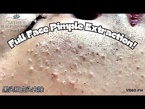 Full Face Pimple Popping , Blackheads, Whiteheads & Hidden Acne Removed with Tweezers | No Filter!