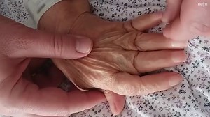69-year-old woman with rheumatoid arthritis presented for treatment