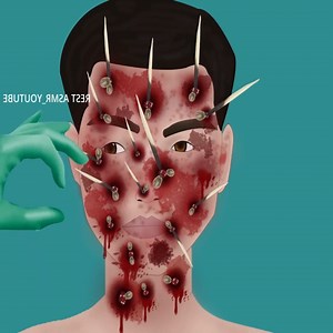 55K views · 335 reactions | Treatment of a beautiful girl with burns face pus healing | Robin's Garden | Facebook