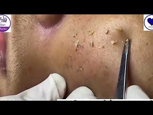 Extracting Closed Comedones on the Forehead: Episode 1 #acne #blackheads#whiteheads #Treatments