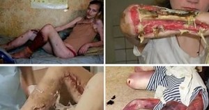Krokodil the zombie drug