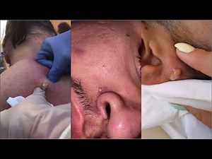 Popping Huge Blackheads and Pimple Popping - Best Pimple Popping Videos 23