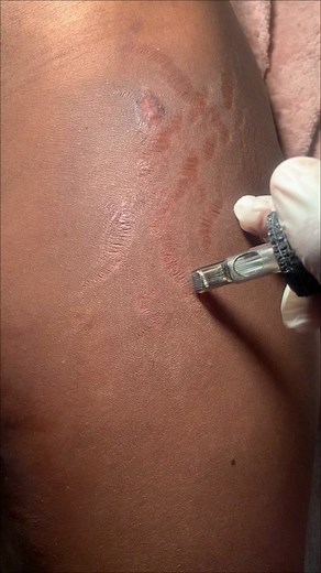 Stretch Marks Removal Techniques and Treatments