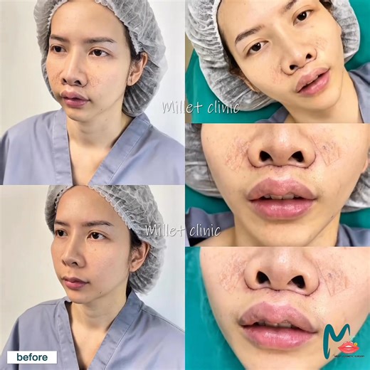 1.1K views | • Upper lip lift ( bullhorn surgery ) คือ...