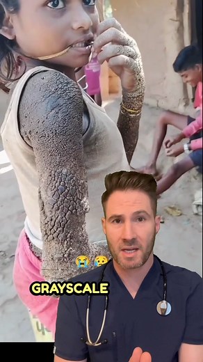 Dr. Joe, M.D. on Instagram: "Tree man syndrome, also known as epidermodysplasia verruciformis, is an extremely rare genetic skin disorder that causes abnormal, excessive growth of skin resembling tree bark. No cure exists for tree man syndrome, but regular removal of growths by surgery combined with specialized creams and treatments can help improve the quality of life for affected individuals. #dermatology #hpv #warts #gameofthrones #badskin"