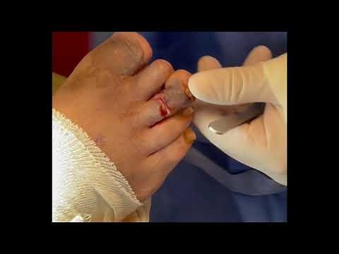 Toe Amputation