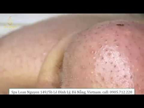 REMOVAL BLACKHEADS for girl 6/14/2020 (192) | Loan Nguyen