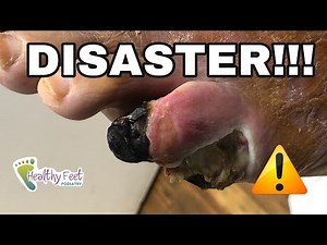 COVID DISASTER! DIABETIC AMPUTATION!!!