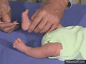 physical exam -Newborn Normal: Reflexes - Plantar Reflex on Make a GIF