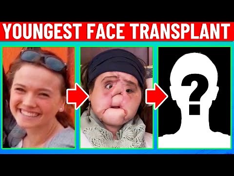 The Youngest Face Transplant! How'd She Do?