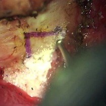 Video: Utilizing a Cranial Window to Visualize the Middle Cerebral Artery During Endothelin-1 Induced Middle Cerebral Artery Occlusion