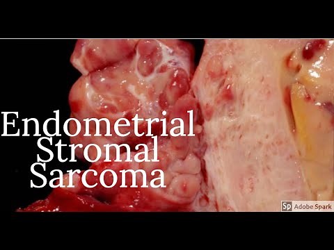 Digital Surgical Pathology 3.8- Endometrial Stromal Sarcoma
