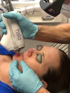 Sciton HALO Laser Treatment Seattle & Bellevue WA