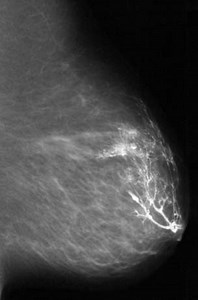 Galactography (Ductography)