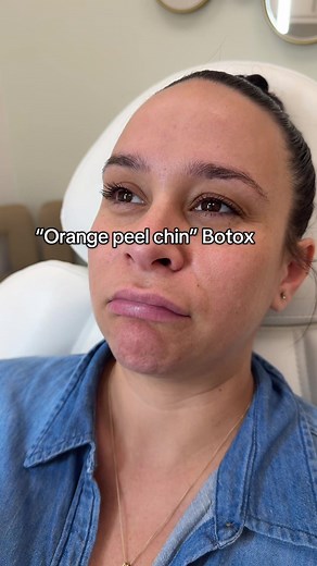 Botox Techniques for a Smooth Chin: Patient Guidance