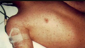 Pain, fever, and chills only the start if diagnosed with typhus