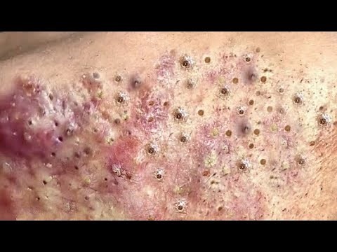 Popping huge blackheads and PimplePopping Best Pimple Popping Videos 10