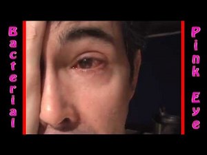 Severe Bacterial Pink Eye Conjunctivitis treatment part 6