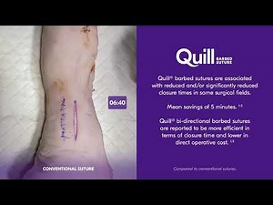 Quill vs Conventional Suture: Speed Demonstration
