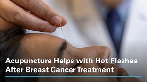 Dana-Farber investigators have found that acupuncture can help alleviate hot flashes associated with hormone therapy after breast cancer treatment, according to new clinical trial research. Learn more: https://bit.ly/4gFZXEt | Dana-Farber Cancer Institute