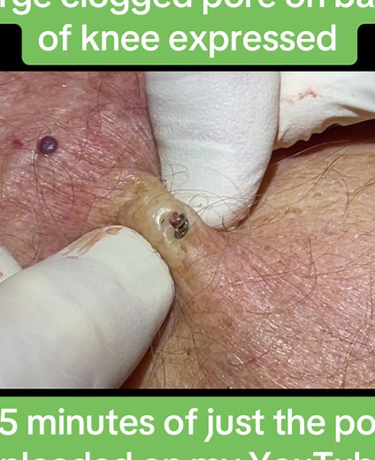 Large Clogged Pore Extraction: 35-Minute Close-Up