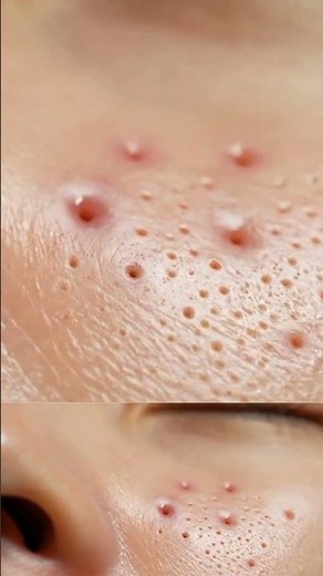 Most Satisfying Face Extraction Ever | Real ASMR Skincare Therapy