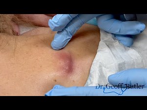Drainage of an Infected Cyst