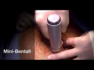 Mini-Bentall Procedure • Video • MEDtube.net