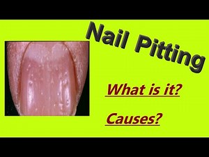 Nail pitting/ Pitted nails