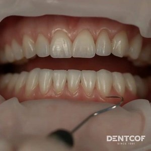 Invisible is my kind of beautiful. Veneer try-in.Ceramics . . By @florincofar @ioanamariapopp #invisible #dentcof | Dentistry blog | Facebook