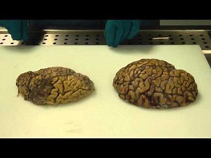 Alzheimer's brain dissection
