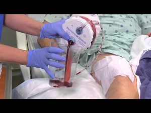 closed wound drainage system video