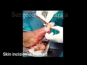 Great toe amputation for diabetic foot/ Disarticulation/ Osteomyelitis/ Digit amputation/Toe removal