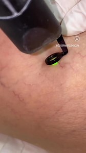 LASER SPIDER VEINS REMOVAL Soft & Smooth legs 懶 NOW ONLY €199 From 7/10 Until 13/10 You can prepay! ☎️Call at. 22871110 #veinspecialist #veinsremoval #spiderveinsremoval #veins #veinspopping #dcdermatologicum #nicosia #skincare #DC #dermatologicum #skinismorethanskin #skinsmooth | DC Dermatologicum | Facebook